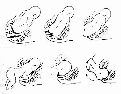 图105 臀位娩出经过(一)臀的娩出 胎臀以较宽的股骨粗隆间径沿骨盆
