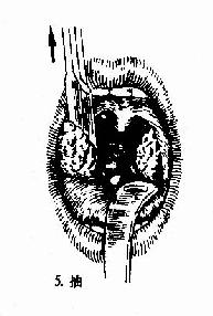 基础知识复习—扁桃体切除术